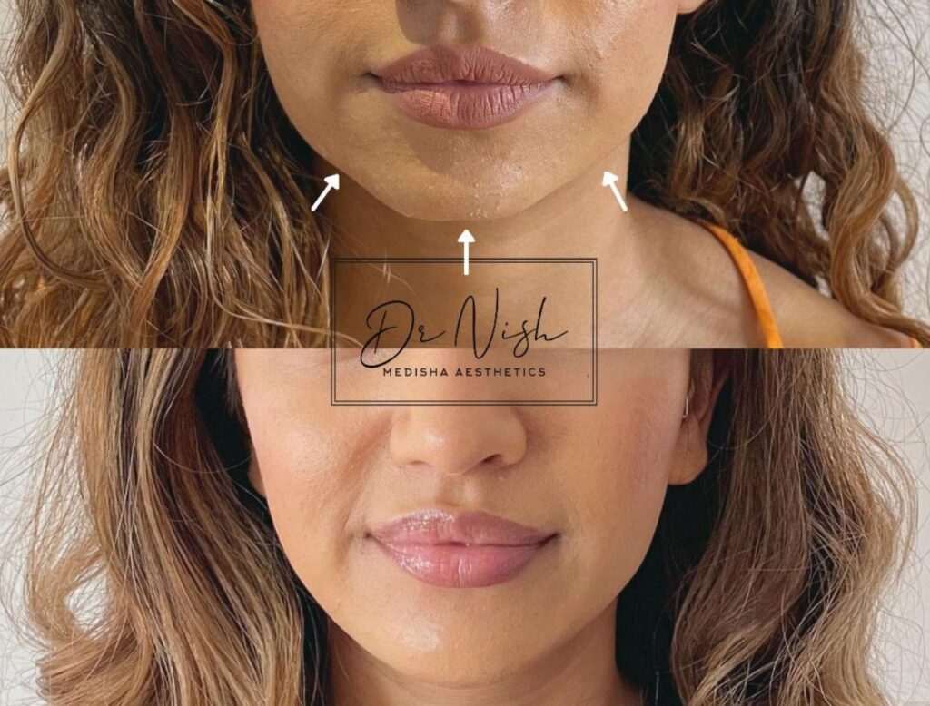 Before and After images of Chin Filler treatment at Medisha Clinic