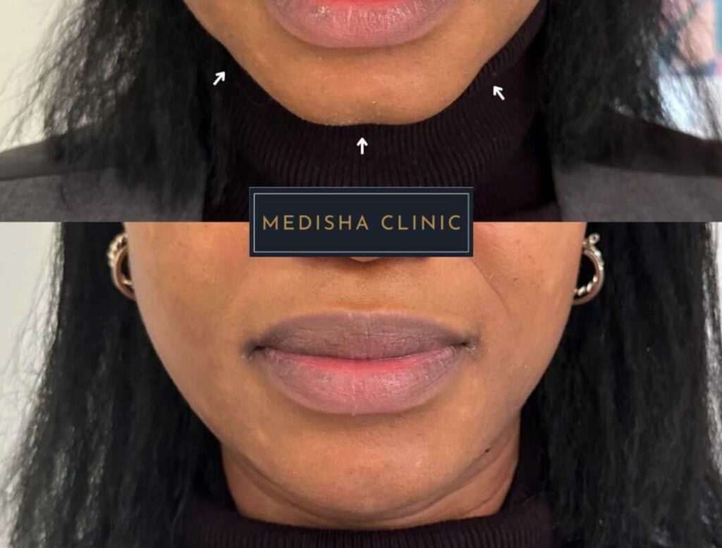 Before and after of a patient at Medisha Clinic who received chin filler treatment