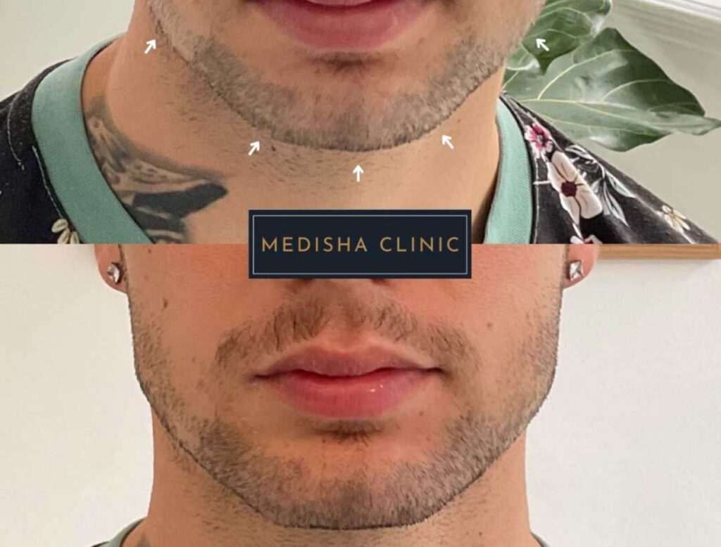A before and after of a patient who had masculinisation treatment at the Medisha Clinic